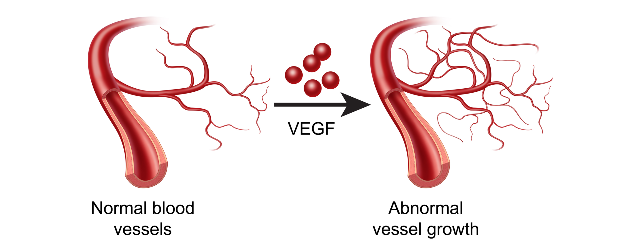 afirma graphic showing normal blood vessels to abnormal vessel growth